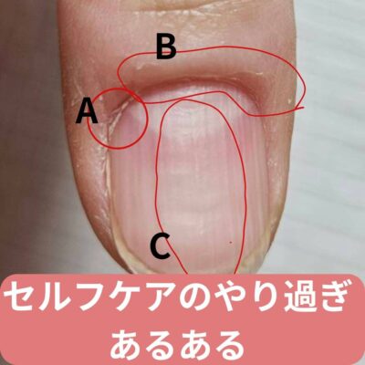 間違ったセルフネイルケアで乾燥した爪と甘皮