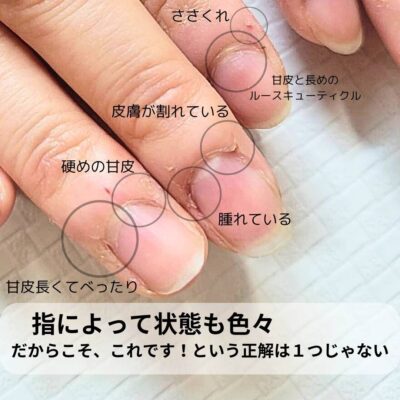 指先にルースキューティクルやささくれが残り荒れている状態